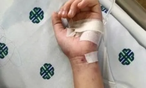 TP.HCM: Bé hơn 2 tuổi tử vong do viêm màng não mô cầu thể tối cấp, diễn tiến rất nhanh