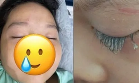 Chỉ 1 phút lơ là mà con gái suýt mù mắt, mẹ bỉm chia sẻ bài học “xương máu” và cách sơ cứu giải nguy trong gang tấc