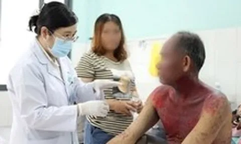 Người đàn ông bị hoại tử thượng bì nhiễm độc nặng sau dùng thuốc nhỏ mắt