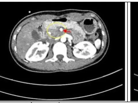 Phương pháp điều trị đem lại hy vọng cho bệnh ung thư đầu tụy giai đoạn tiến triển
