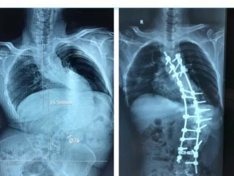 Tìm lại vóc dáng cho bệnh nhân bị biến dạng cột sống kèm gù hơn 100 độ