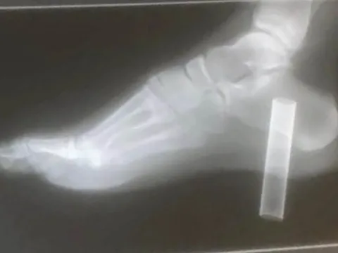 Suýt mất chân vì nghịch thuốc lá điện tử