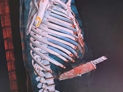 Cứu sống bệnh nhân nhập viện trong tình trạng dao đâm xuyên bụng