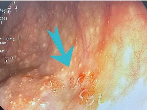 Người phụ nữ đi khám vì đau bụng dữ dội, bác sĩ sốc nặng khi thấy thứ đáng sợ bên trong