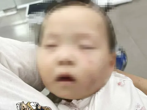 Tạm giữ nữ giáo viên trong vụ bé gái có nhiều vết bầm tím chi chít trên mặt