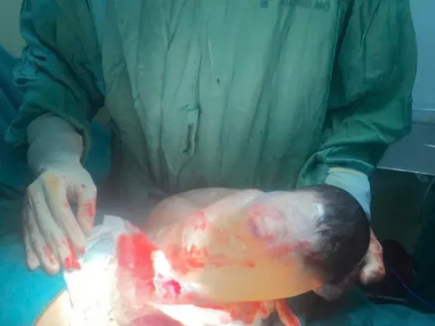 Khoảnh khắc hiếm gặp: Trẻ sơ sinh chào đời còn nguyên trong bọc ối