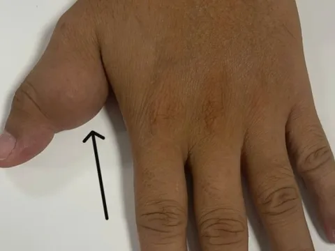 Tưởng 'thịt thừa' ở ngón tay, không ngờ là khối u ăn mòn xương