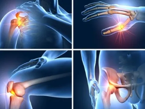 Thoái hóa khớp giai đoạn sớm: Nên bắt đầu bằng thuốc bôi tại chỗ và tập luyện