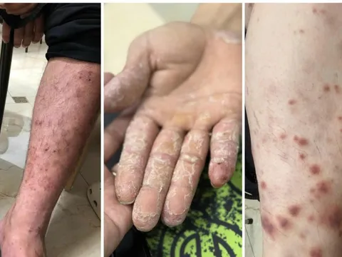 5 bệnh da liễu thường gặp trong mùa mưa lũ và cách xử lý