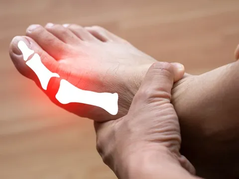 Đau do bệnh gút, các liệu pháp điều trị tự nhiên