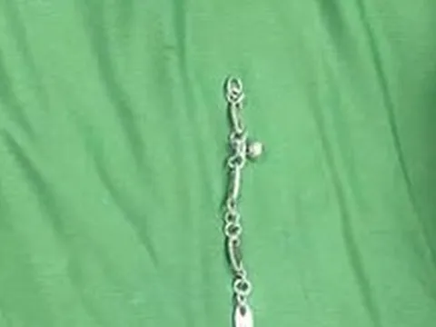 Bé gái 5 tuổi nuốt vòng tay bạc dài 7cm, sơ cứu đúng cách giúp trẻ thoát nguy hiểm