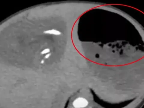 Bụng bé gái sưng to bất thường, bác sĩ phát hiện ra "bí mật" đáng sợ