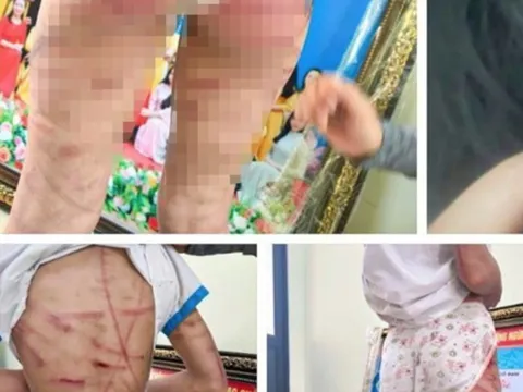Vụ bé gái lớp 5 bị cha dượng bạo hành: Công an thông tin chính thức