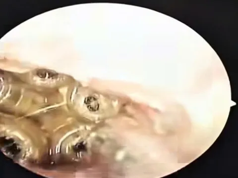 Nữ bệnh nhân nhập viện vì đau tai, bác sĩ gắp ra 5 con giòi sống