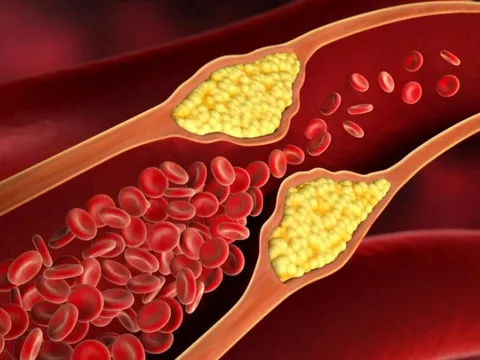 Chế độ ăn phòng tăng mỡ máu ở người cao tuổi