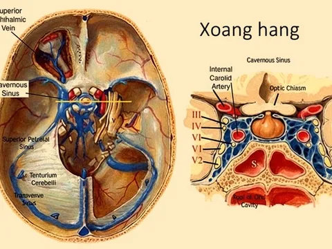 Ngạt mũi, đau đầu, thanh niên 25 tuổi nhập viện vì nhiễm trùng sọ
