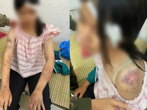 Thông tin mới vụ bé gái 13 tuổi bị tra khảo, đánh đập dã man, người chi chít vết thương