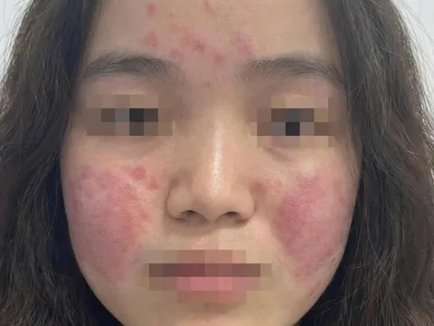 Cô gái trẻ đỏ rát mặt vì ô nhiễm không khí, bác sĩ hướng dẫn cách bảo vệ da