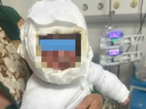 Bé 9 tháng tuổi bỏng 30% cơ thể vì kéo dây điện ấm siêu tốc