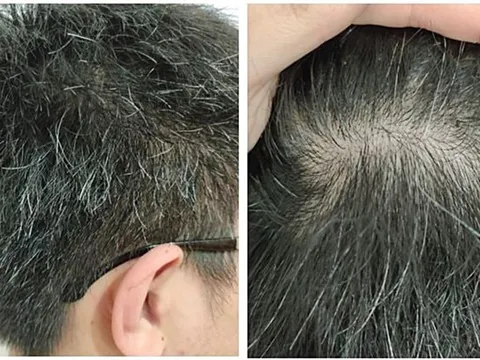 Có phải ‘tóc bạc nhiều là dấu hiệu của ung thư’?