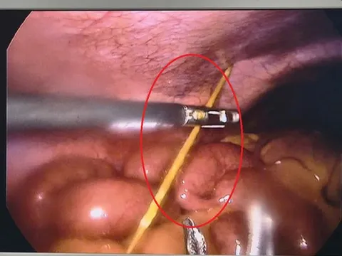 Đau bụng dữ dội, bác sĩ phát hiện thứ "đáng sợ" bên trong