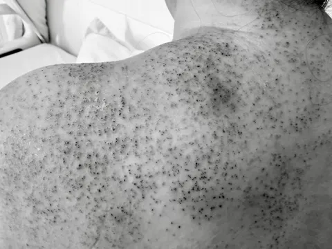 Người phụ nữ nhập viện cấp cứu sau khi chích lể, giác hơi