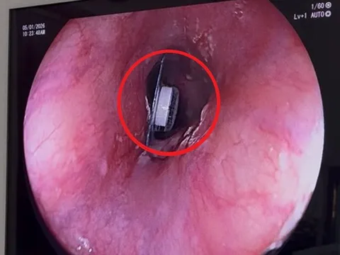 Người phụ nữ 60 tuổi đau ngực thốc ngược lên, bác sĩ phát hiện bí mật "đáng sợ" bên trong