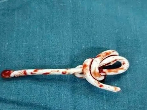 Bé trai cấp cứu do nhét dây vào lỗ tiểu, theo clip 'thử thách' trên mạng