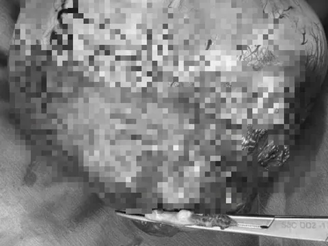 Đi siêu âm, người đàn ông sốc nặng khi thấy vật thể "lạ" khổng lồ trong ổ bụng