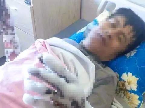 Bị phóng điện, người đàn ông bỏng nặng cả hai tay