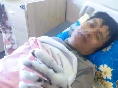 Một công nhân bị bỏng nặng 2 tay do phóng điện