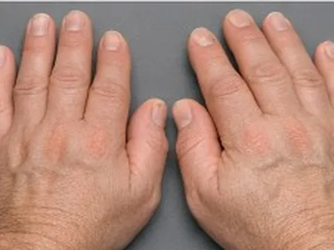 Bỗng dưng bàn tay, bàn chân to ra: Có thể là dấu hiệu bệnh lý nguy hiểm