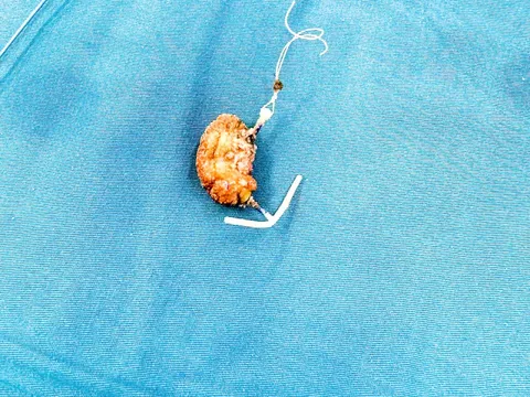 Lấy được vòng tránh thai nhiều sỏi bám do ‘đi lạc’ vào bàng quang sau 22 năm đặt