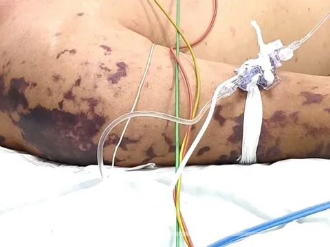 Ăn thịt lợn ở đám cỗ, người đàn ông 52 tuổi lơ mơ, nguy kịch