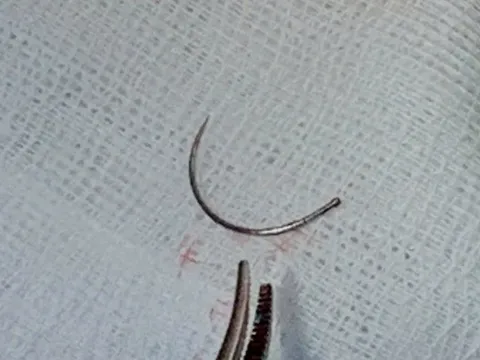 Lấy dị vật kim khâu nằm trong tầng sinh môn nữ bệnh nhân sau 11 năm