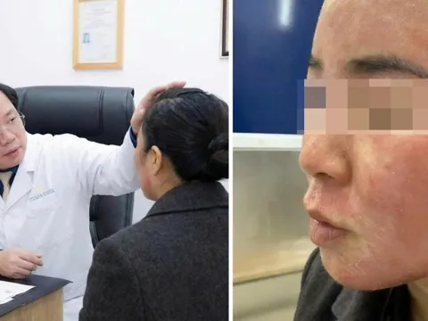 Đang gội đầu được mời ‘làm đẹp cấp tốc’ đón Tết, cô gái hỏng cả khuôn mặt