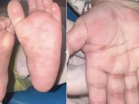 Bé trai gần 3 tuổi mắc giang mai dù không có triệu chứng