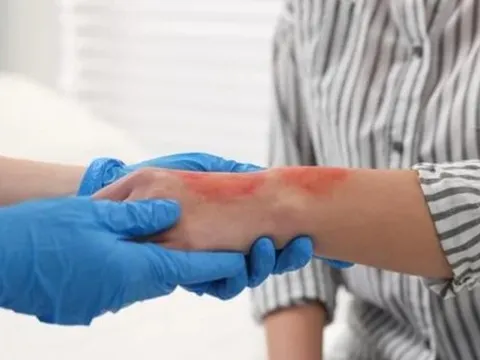 Cách xử trí những tình huống thường gặp ngày Tết, chuyên gia khuyến cáo tránh xa 'mẹo'