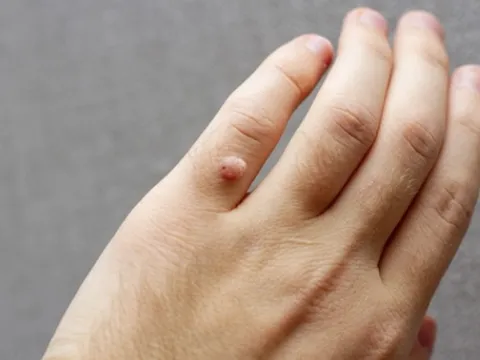 Bệnh hạt cơm lây như thế nào và nguy hiểm ra sao?