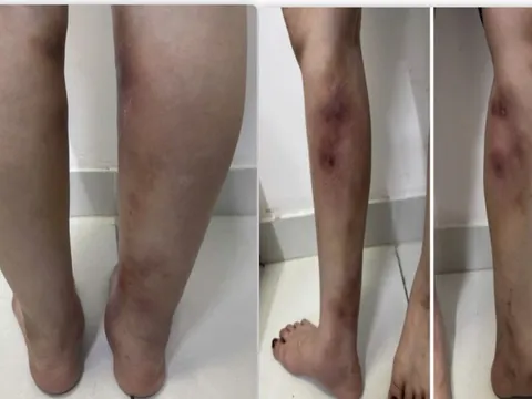 Chân biến dạng sau tiêm filler làm thẳng chân tại nhà