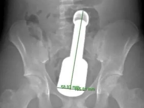 Thiếu niên 15 tuổi cấp cứu vì chiếc chày 18cm mắc kẹt ở hậu môn