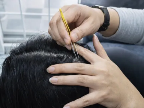 Nhổ tóc bạc cho 'đỡ ngứa mắt', coi chừng tóc không mọc lại