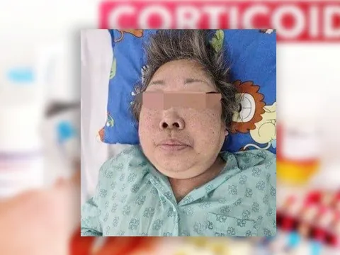 'Uống thấy dễ chịu' nhưng khuôn mặt biến dạng, suy thượng thận mạn vì lạm dụng corticoid