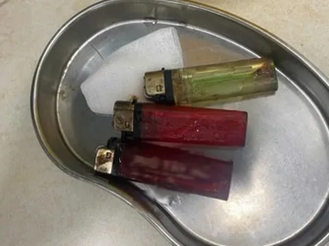 Bác sĩ sốc khi phát hiện 3 chiếc bật lửa trong bụng nam thanh niên