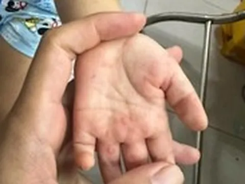 Báo động trẻ tử vong vì bệnh tay chân miệng tăng nhanh