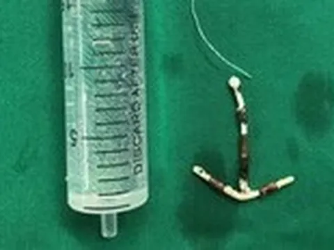 Lấy vòng tránh thai lạc chỗ suốt 1/4 thế kỷ