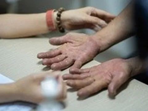 Vừa nắng nóng đầu mùa, bệnh da liễu đã bùng phát: Làm gì để phòng tránh?