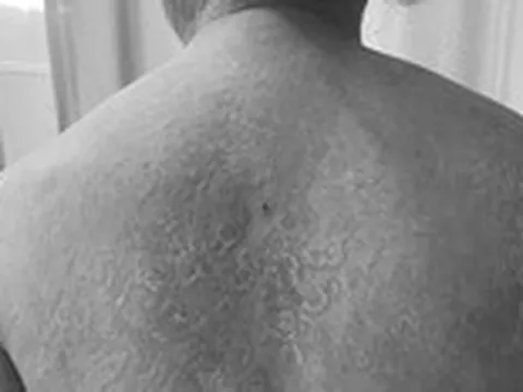 Tự ý bôi kem trộn, tắm lá, người phụ nữ bị nấm da lan khắp cơ thể