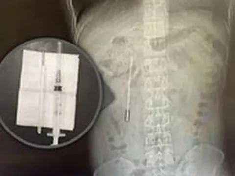 Đau bụng đi khám, phát hiện nhiệt kế nằm trong cơ thể suốt 20 năm