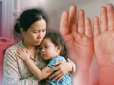 Ba bệnh rình rập trẻ nhỏ mùa nắng